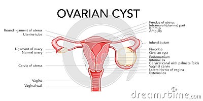 Ovarian cyst diagram Female reproductive system uterus labeled in Anatomical infographic. Front view gynecological Vector Illustration