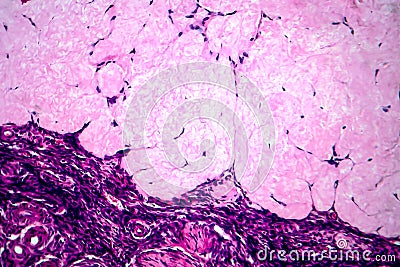 Ovarian cyst, light micrograph Stock Photo