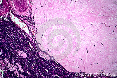 Ovarian cyst, light micrograph Stock Photo