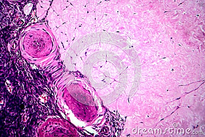 Ovarian cyst, light micrograph Stock Photo