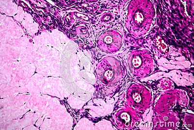 Ovarian cyst, light micrograph Stock Photo