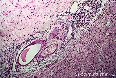 Ovarian cyst, light micrograph Stock Photo