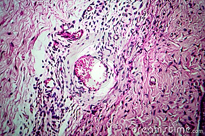 Ovarian cyst, light micrograph Stock Photo