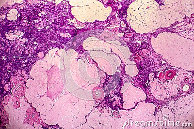 Ovarian cyst, light micrograph, photo under microscope Stock Photo