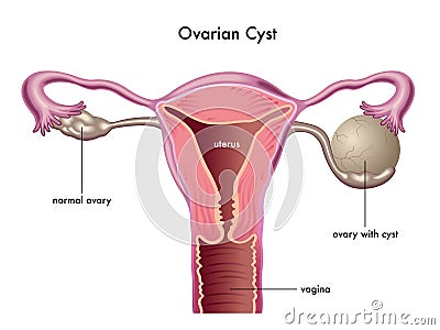 Ovarian cyst Vector Illustration