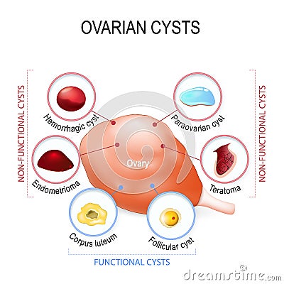 Ovarian cyst Vector Illustration