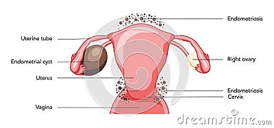 Ovarian endometriomas chocolate cysts Female reproductive system uterus problem diagram with inscriptions. Human medical Vector Illustration