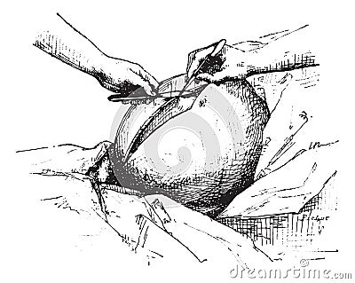 Ovariectomy or Oophorectomy, vintage engraving Vector Illustration