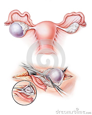 Ovaries - Cystectomy Stock Photo