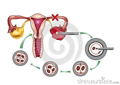 Ovary problem Cartoon Illustration