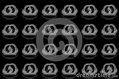 Overview of a computed tomography scan of a patient with a lung tumor Stock Photo