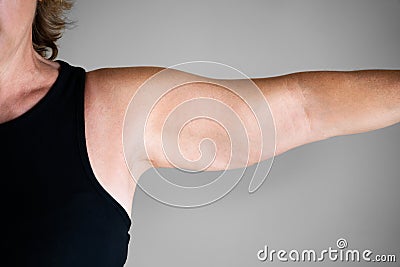 Overweight Lady Arm With Excess Fat Stock Photo