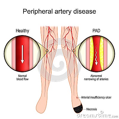 PAD. Peripheral Artery Disease. Vascular disease Vector Illustration