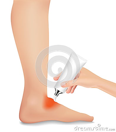 The injured foot is red and swollen like a realistic, treatment with medication. EPS10 Vector Illustration