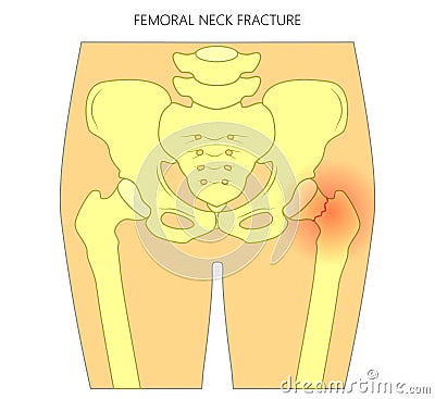 Pain in the hip joint_femoral neck fracture Vector Illustration