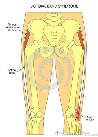 Pain in the hip joint iliotibial band syndrome Vector Illustration