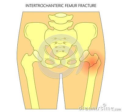 Pain in the hip joint_intertrochanteric femur fracture Vector Illustration