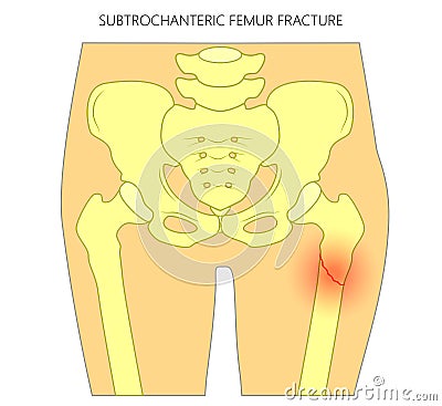 Pain in the hip joint_subtrochanteric femur fracture Vector Illustration