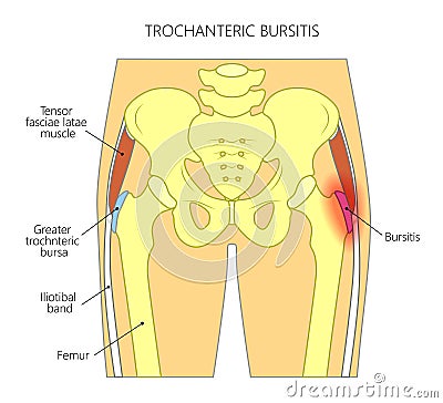 Pain in the hip joint_trochanteric bursitis Vector Illustration