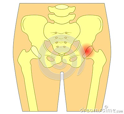 Pain in the hip joint Vector Illustration