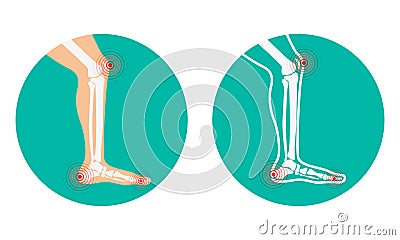 Pain in legs. knee pain, heel pain. Vector Illustration