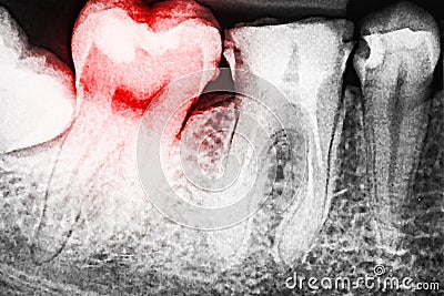 Pain Of Tooth Decay On X-Ray Stock Photo