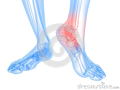 Painful ankle illustration Cartoon Illustration