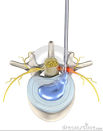 Painful herniated disk, minimally invasive operation, medically 3D illustration on white background Cartoon Illustration