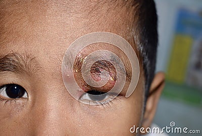 Painful, large abscess or Staphylococcal / Streptococcal skin infection or carbuncles in face of Southeast Asian Burmese child. Stock Photo