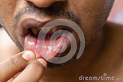 Painful mouth ulcer Stock Photo