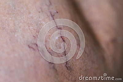 Painful varicose and spider veins Stock Photo