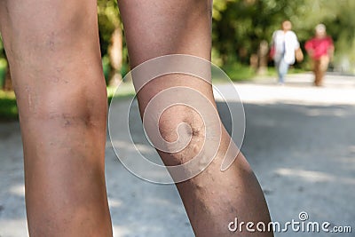 Painful varicose and spider veins on womans legs Stock Photo