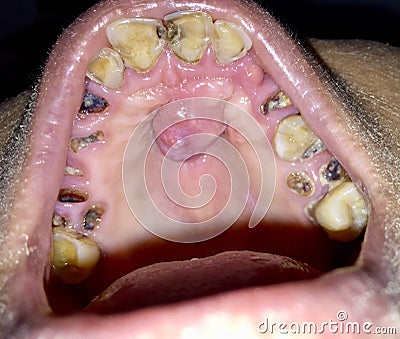 A painless benign growth called palatal torus in the midline of hard palate and broken and stained teeth with caries in mouth. Stock Photo