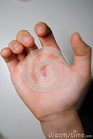 The palm of an athlete's hand after training A lacerated callus on the palm of my hand Stock Photo