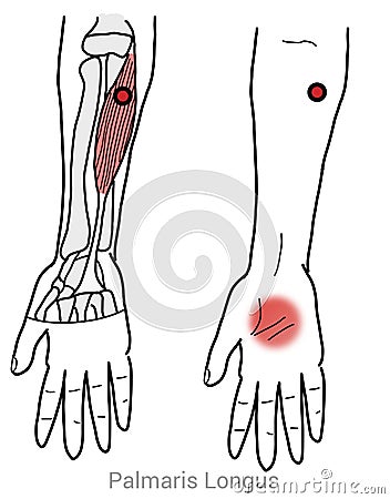 Palmaris longus myofascial trigger points and hand palm pain Cartoon Illustration