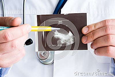 Pancreas cyst on ultrasound image concept photo. Doctor indicating by pen on printed picture ultrasound pathology lesion - pancrea Stock Photo