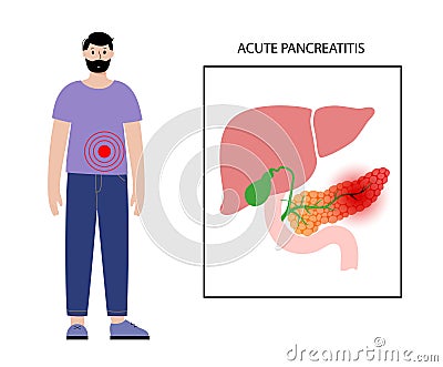 Pancreas disease and cancer Vector Illustration