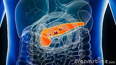 Pancreas or pancreatic cancer with organs and tumors or cancerous cells 3D rendering illustration with male body. Anatomy, Cartoon Illustration