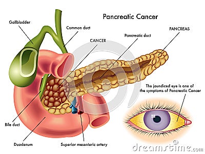 Pancreatic cancer Vector Illustration