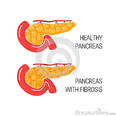 Pancreatic fibrosis concept. Vector illustration Vector Illustration