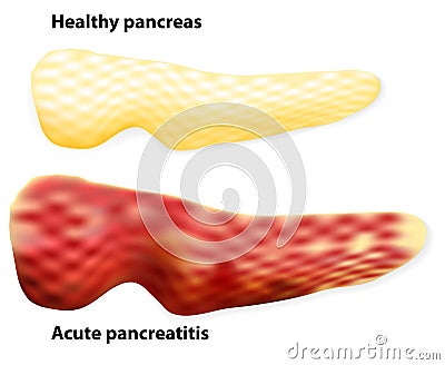 Pancreatitis. The differences between healthy pancreas and inflamed pancreas Vector Illustration