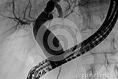 Pancreatography image of upper gastroenterology endoscopy. Stock Photo