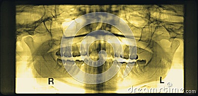 Full mouth dental xray (x-ray) Stock Photo
