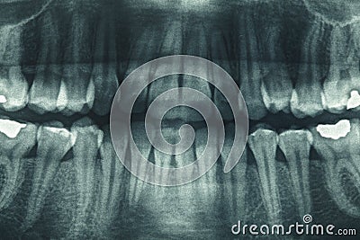 Panoramic dental X-Ray Stock Photo