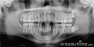 Panoramic Dental X-ray Stock Photo