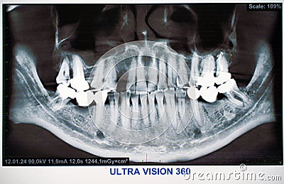 Panoramic Dental X-Ray with broken tooth Stock Photo