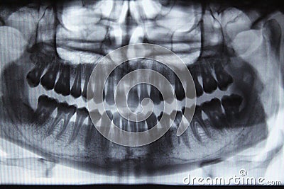 Panoramic dental X-ray Stock Photo