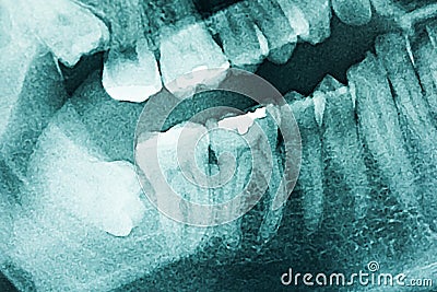 Panoramic Dental X-Ray Stock Photo