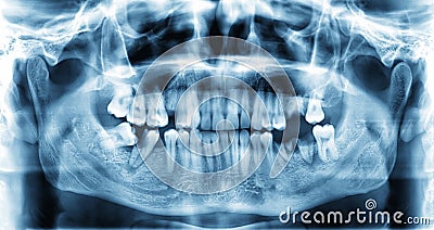 Panoramic dental x-ray image of teeth Stock Photo