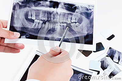 Panoramic dental x-ray image of teeth. Stock Photo